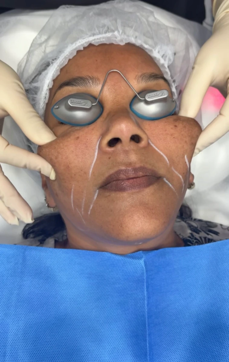 Endolift-aamedspas-e