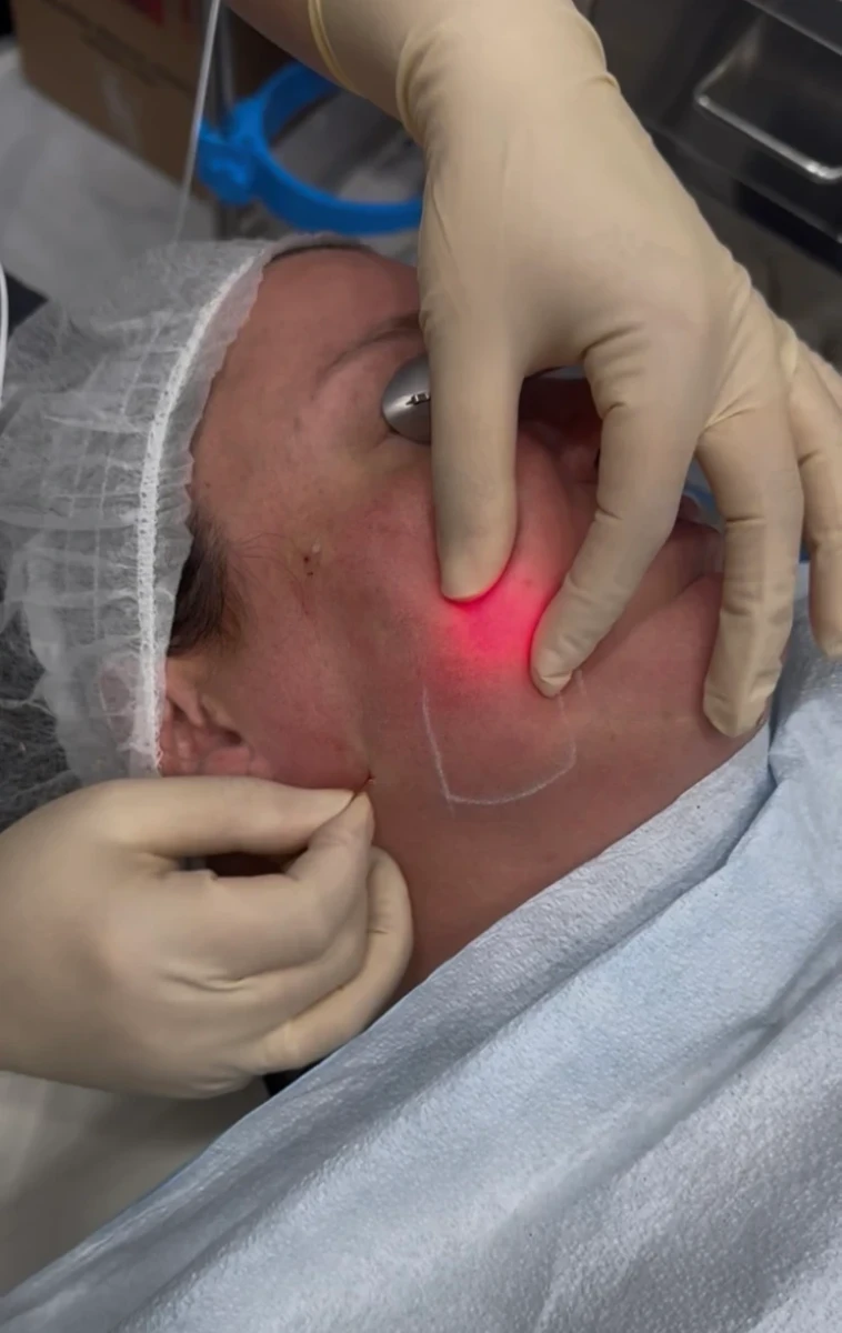 Endolift-aamedspas-f