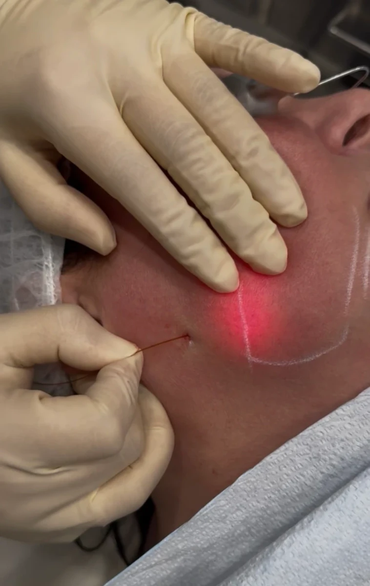 Endolift-aamedspas-g