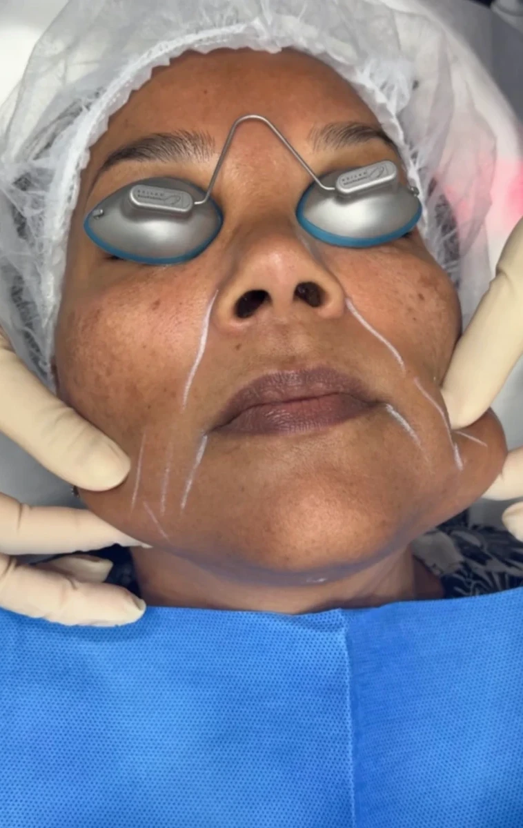 Endolift-aamedspas-h